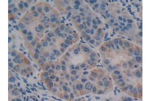 DAB staining on IHC-P; Samples: Human Liver cancer Tissue (Olfactomedin 4 anticorps  (AA 407-510))