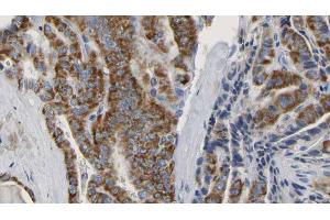 ABIN6267150 at 1/100 staining Human thyroid cancer tissue by IHC-P. (NCF4 anticorps  (pThr154))