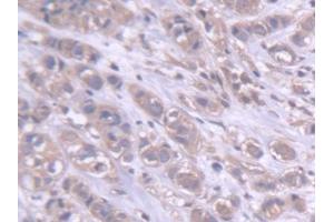 DAB staining on IHC-P; Samples: Human Breast cancer Tissue