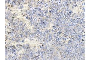 ABIN6256596 and ABIN6267259 at 1/100 staining human melanoma by IHC-P.