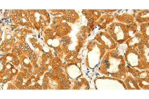 Immunohistochemistry of paraffin-embedded Human thyroid cancer using NAPA Polyclonal Antibody at dilution of 1:35 (NAPA anticorps)