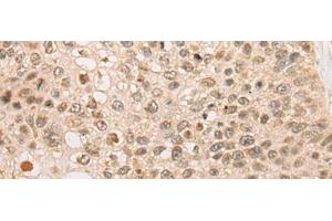 Immunohistochemistry of paraffin-embedded Human lung cancer tissue using CAPN15 Polyclonal Antibody at dilution of 1:50(x200) (Calpain 15/SOLH anticorps)