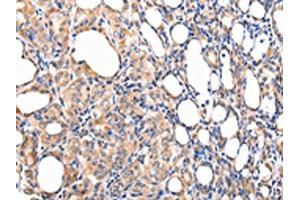 The image on the left is immunohistochemistry of paraffin-embedded Human thyroid cancer tissue using ABIN7190092(CCL7 Antibody) at dilution 1/20, on the right is treated with synthetic peptide. (CCL7 anticorps)