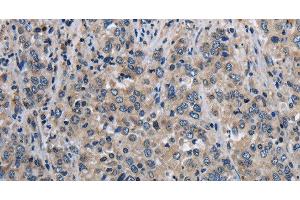 Immunohistochemistry of paraffin-embedded Human liver cancer using MCM3AP Polyclonal Antibody at dilution of 1:30 (GANP anticorps)