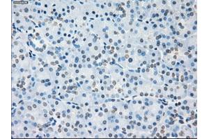 Immunohistochemical staining of paraffin-embedded Adenocarcinoma of colon tissue using anti-SORDmouse monoclonal antibody. (SORD anticorps)