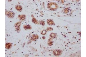 IHC image of ABIN7127365 diluted at 1:100 and staining in paraffin-embedded human breast cancer performed on a Leica BondTM system.