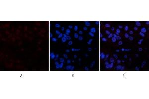 Immunofluorescence analysis of human liver cancer tissue. (PARP1 anticorps  (cleaved))