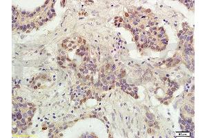 Formalin-fixed and paraffin embedded human ovarian carcinoma labeled with Rabbit Anti-P53 protein(wt-p53) Polyclonal Antibody (ABIN723935), Unconjugated 1:300 followed by conjugation to the secondary antibody and DAB staining (p53 anticorps  (AA 251-310))