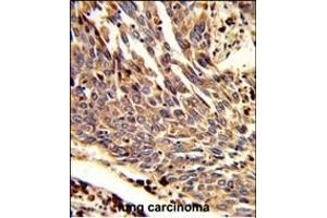 Formalin-fixed and paraffin-embedded human lung carcinoma reacted with ARPC1B Antibody (Center), which was peroxidase-conjugated to the secondary antibody, followed by DAB staining. (ARPC1B anticorps  (AA 159-188))