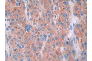 DAB staining on IHC-P; Samples: Human Liver cancer Tissue
