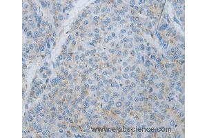 Immunohistochemistry of Human liver cancer using MMP25 Polyclonal Antibody at dilution of 1:80 (MMP25 anticorps)
