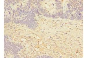 Immunohistochemistry of paraffin-embedded human ovarian cancer using ABIN7160074 at dilution of 1:100 (MAP4K5 anticorps  (AA 300-480))