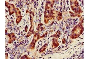 Immunohistochemistry of paraffin-embedded human pancreatic cancer using ABIN7160874 at dilution of 1:100 (NQO1 anticorps  (AA 55-155))