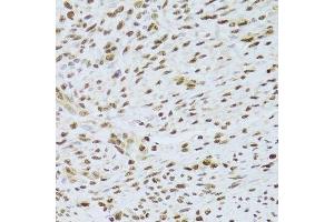 Immunohistochemistry of paraffin-embedded human adenomyosis using ANP32A Antibody.