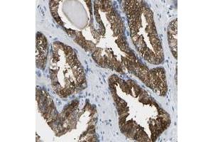 Immunohistochemical staining of human prostate with NDRG3 polyclonal antibody  strong cytoplasmic positivity in glandular cells. (NDRG3 anticorps)