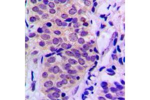 Immunohistochemical analysis of BAD (pS155) staining in human prostate cancer formalin fixed paraffin embedded tissue section. (BAD anticorps  (C-Term, pSer155))