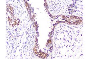 IHC testing of FFPE human breast cancer with Beta Catenin antibody.