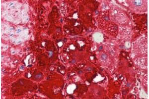 Human Adrenal (formalin-fixed, paraffin-embedded) stained with TH antibody ABIN462131 followed by biotinylated goat anti-rabbit IgG secondary antibody ABIN481713, alkaline phosphatase-streptavidin and chromogen.