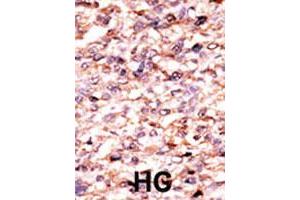 Formalin-fixed and paraffin-embedded human hepatocellular carcinoma tissue reacted with ACVR1C polyclonal antibody  , which was peroxidase-conjugated to the secondary antibody, followed by AEC staining. (ACVR1C/ALK7 anticorps  (N-Term))