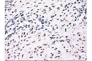 Immunohistochemical staining of paraffin-embedded colon tissue using anti-BRAFmouse monoclonal antibody. (BRAF anticorps)
