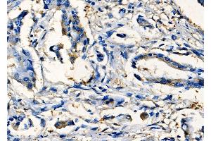 ABIN6265096 and ABIN6277789 at 1/100 staining Human colorectal cancer by IHC-P. (SIX2 anticorps  (Internal Region))