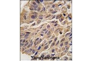 Formalin-fixed and paraffin-embedded human lung carcinoma tissue reacted with INDO antibody (C-term) (ABIN389194 and ABIN2839357) , which was peroxidase-conjugated to the secondary antibody, followed by DAB staining. (IDO1 anticorps  (C-Term))