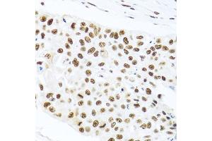 Immunohistochemistry of paraffin-embedded human lung cancer using PRPF19 antibody. (PRP19 anticorps)