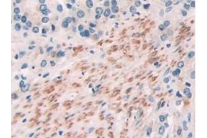 Detection of SOCS2 in Human Prostate cancer Tissue using Polyclonal Antibody to Suppressors Of Cytokine Signaling 2 (SOCS2)