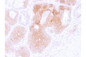 Formalin-fixed, paraffin-embedded human Prostate Carcinoma stained with CD44v6 Mouse Monoclonal Antibody (CD44V6/2496). (CD44 anticorps)