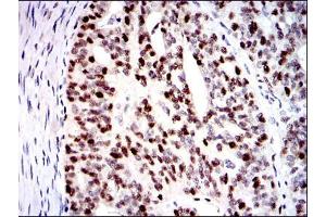 Immunohistochemical analysis of paraffin-embedded ovarian cancer tissues using MCM2 mouse mAb with DAB staining.