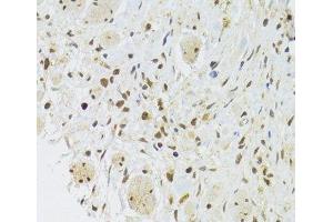 Immunohistochemistry of paraffin-embedded Human gastric cancer using EFTUD2 Polyclonal Antibody at dilution of 1:100 (40x lens).