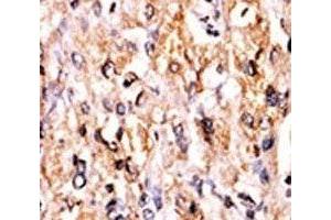 IHC analysis of FFPE human hepatocarcinoma tissue stained with the GCN2 antibody (GCN2 anticorps  (AA 1-30))