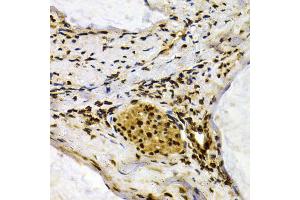 Immunohistochemistry of paraffin-embedded human colon carcinoma using IFIH1 antibody (ABIN5971229) at dilution of 1/200 (40x lens). (IFIH1 anticorps)
