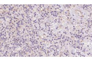 ABIN6273088 at 1/100 staining Human lymph cancer tissue by IHC-P. (ACADVL anticorps  (Internal Region))