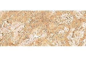 Immunohistochemistry of paraffin-embedded Human ovarian cancer tissue using TRMT112 Polyclonal Antibody at dilution of 1:30(x200) (TRMT112 anticorps)
