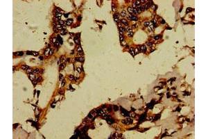 Immunohistochemistry of paraffin-embedded human pancreatic cancer using ABIN7167538 at dilution of 1:100