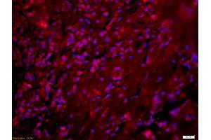Formalin-fixed and paraffin-embedded human breast carcinoma labeled with Anti-Phospho-NFKB p65(Ser276) Polyclonal Antibody, Unconjugated (ABIN700555) 1:200, overnight at 4°C, The secondary antibody was Goat Anti-Rabbit IgG, Cy3 conjugated used at 1:200 dilution for 40 minutes at 37°C.