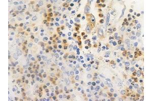 ABIN6261154 and ABIN6266525 at 1/100 staining human colon carcinoma by IHC-P.