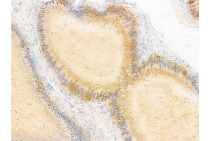 ABIN7096897 and ABIN7100963 at 1/100 staining human testicular cancer by IHC-P.