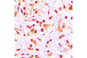 Immunohistochemical analysis of Histone H4 (AcK8) staining in human lung cancer formalin fixed paraffin embedded tissue section. (Histone H4 anticorps  (acLys8, N-Term))