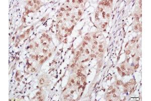 Paraformaldehyde-fixed, paraffin embedded human esophageal cancer, Antigen retrieval by boiling in sodium citrate buffer (pH6) for 15min, Block endogenous peroxidase by 3% hydrogen peroxide for 30 minutes, Blocking buffer (normal goat serum) at 37°C for 20min, Antibody incubation with FOG1 Polyclonal Antibody, Unconjugated  at 1:400 overnight at 4°C, followed by a conjugated secondary and DAB staining.