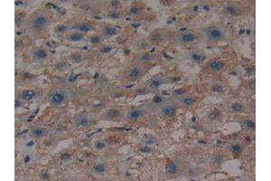 Detection of SHH in Human Liver cancer Tissue using Polyclonal Antibody to Hedgehog Homolog, Sonic (SHH)