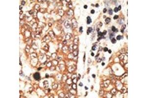 IHC analysis of FFPE human hepatocarcinoma tissue stained with the NRG2 antibody