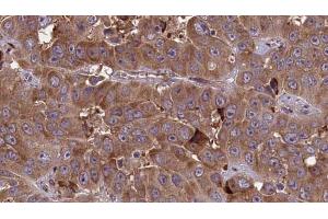 ABIN6273702 at 1/100 staining Human liver cancer tissue by IHC-P. (Cyclin M3 anticorps  (Internal Region))