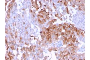 Formalin-fixed, paraffin-embedded human Urothelial Carcinoma stained with Uroplakin 1B Mouse Monoclonal Antibody (UPK1B/3102). (Uroplakin 1B anticorps  (AA 109-229))