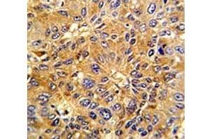IHC analysis of FFPE human hepatocarcinoma with Cyclin A2 antibody