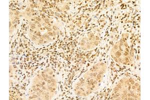 ABIN6265927 and ABIN6273024 at 1/100 staining Human lung cancer by IHC-P.