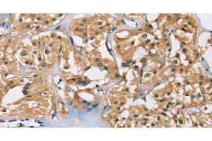 Immunohistochemistry of paraffin-embedded Human thyroid cancer using PPP3CA Polyclonal Antibody at dilution of 1:40
