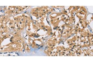 Immunohistochemistry of paraffin-embedded Human thyroid cancer using PPP3CA Polyclonal Antibody at dilution of 1:40 (PPP3CA anticorps)