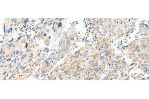 Immunohistochemistry of paraffin-embedded Human cervical cancer tissue using NXNL1 Polyclonal Antibody at dilution of 1:45(x200) (NXNL1 anticorps)